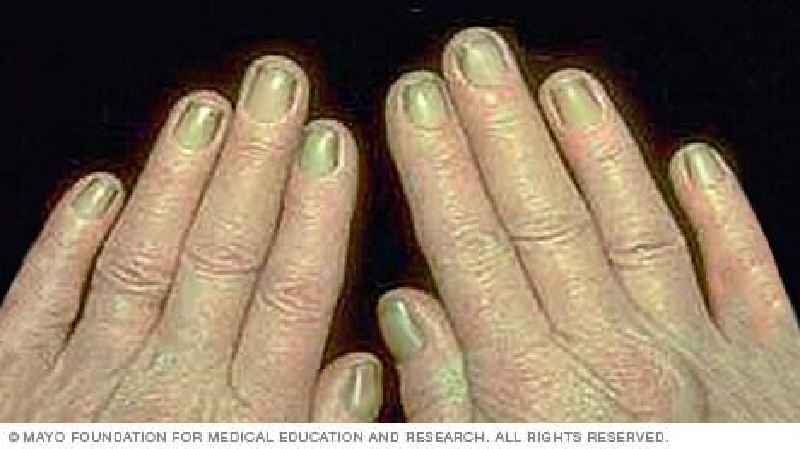 What diseases cause nail pitting
