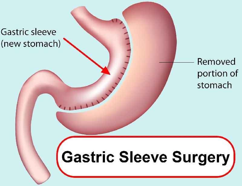 What disqualifies the gastric sleeve