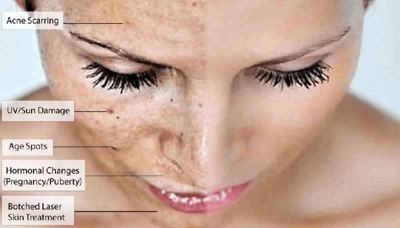 What do dermatologist do for dark spots