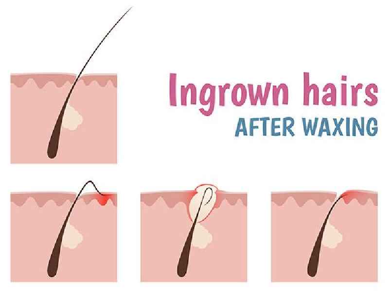 What do dermatologists recommend for ingrown hairs