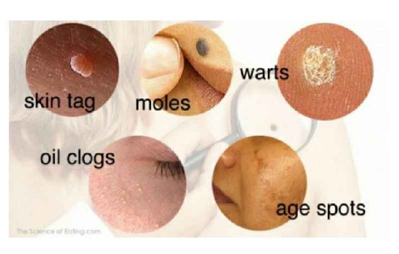 What do dermatologists use to remove warts