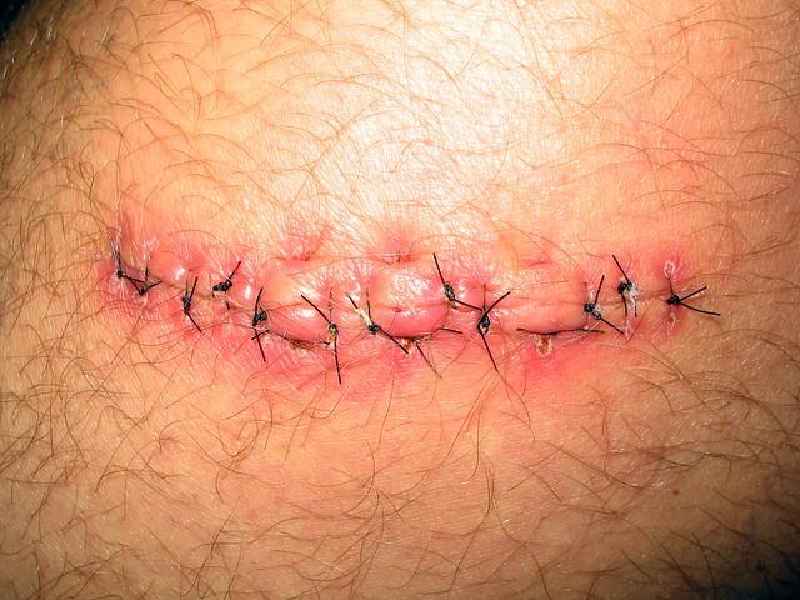 What do infected stitches look like