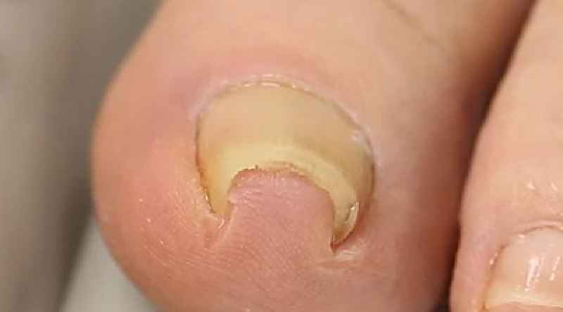 What do Podiatrists do for ingrown toenails