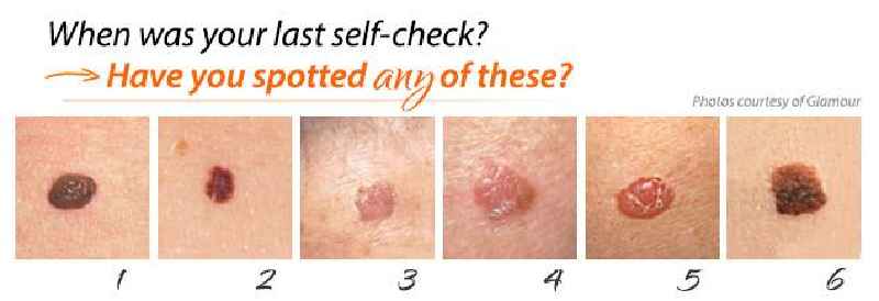 What do skin cancers look like on your face