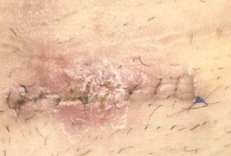 What do you put on skin after stitches are removed