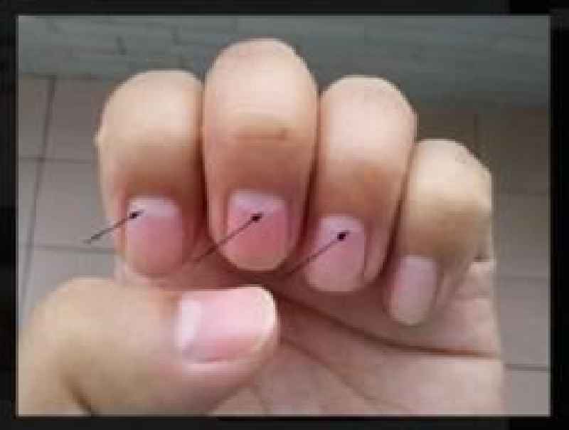 What do your nails look like if you have cancer