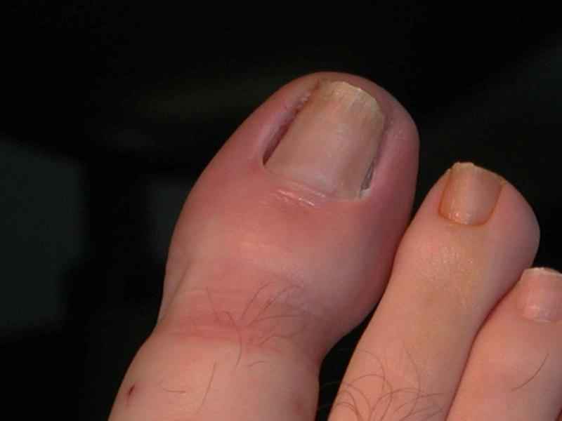 What does a bacterial nail infection look like