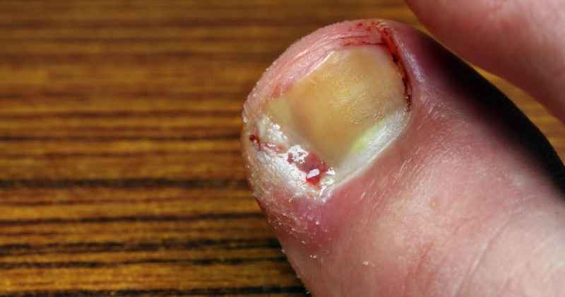 What does a infected ingrown toenail look like