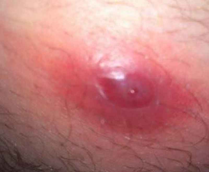 What does a ingrown hair cyst look like