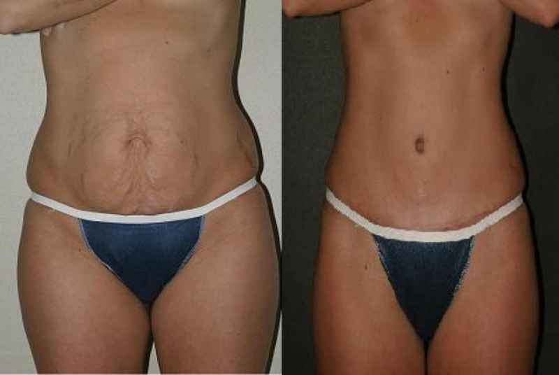 What does a tummy tuck scar look like