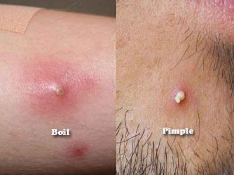 What does an ingrown pimple look like