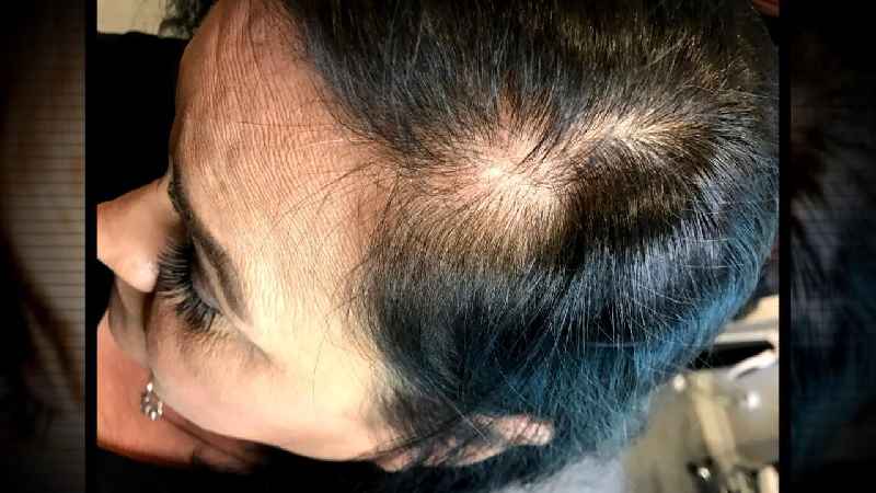 What does anemia hair loss look like