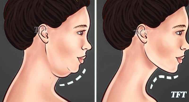 What does chin augmentation do
