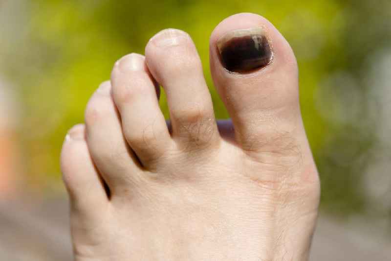 What does diabetes do to your toes
