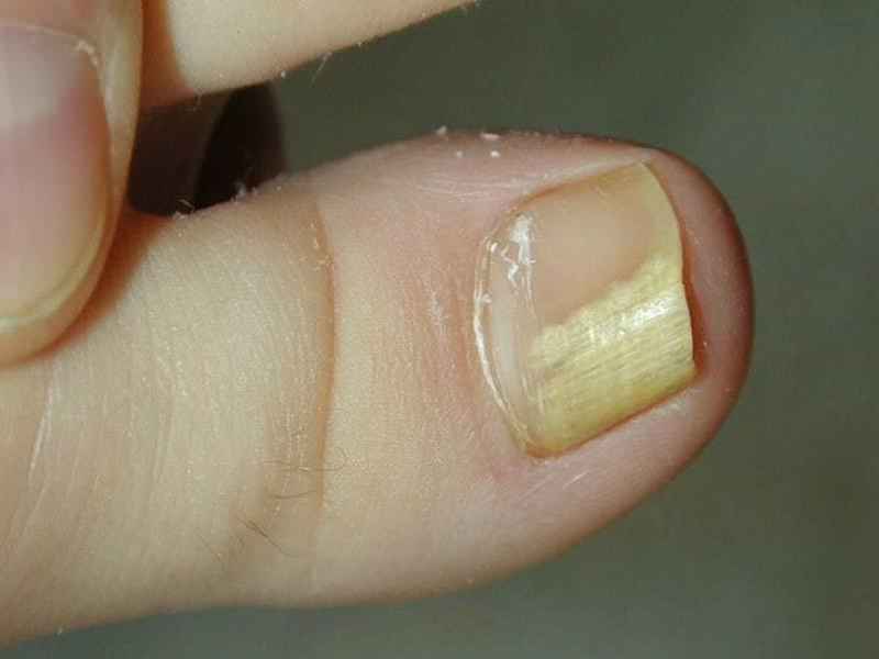 What does diabetic nails look like