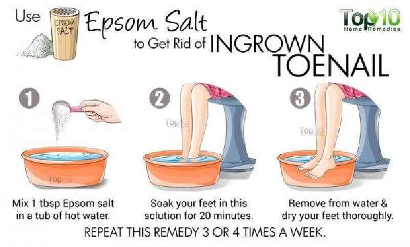 What does Epsom salt do for toenail removal