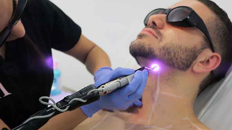 What does full face laser hair removal include