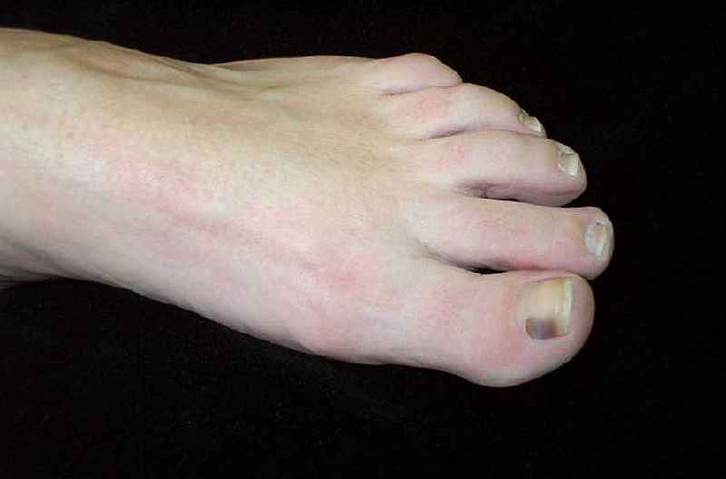 What does it mean when your toenail is throbbing