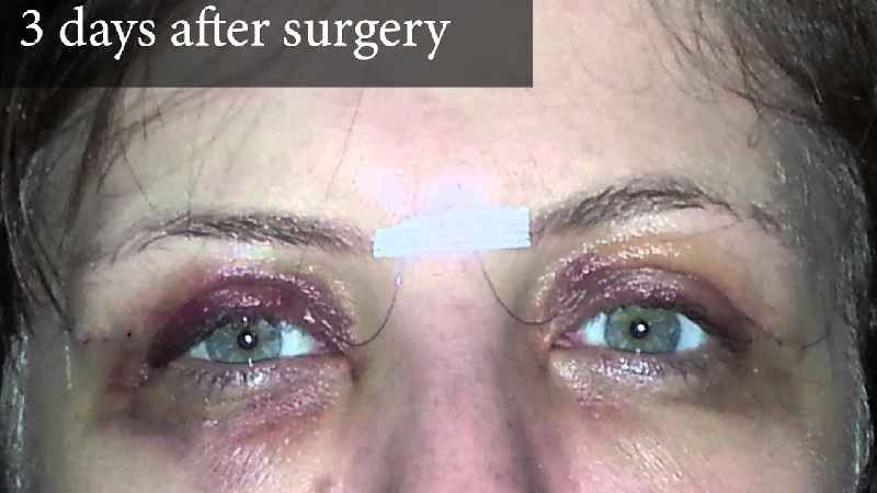 What does lower lid surgery do