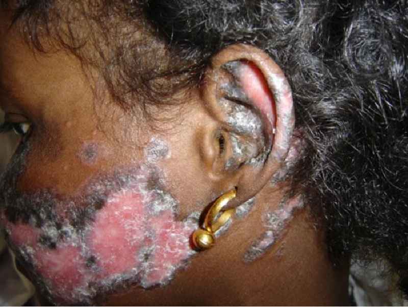 What does lupus on the scalp look like