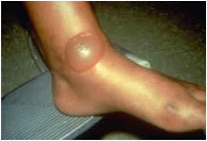 What does swollen feet mean for a diabetic