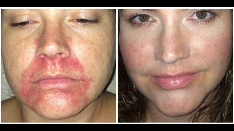What does your face look like after an IPL treatment
