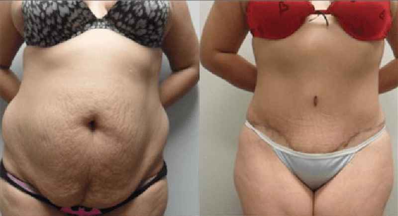 What does your stomach look like after a tummy tuck
