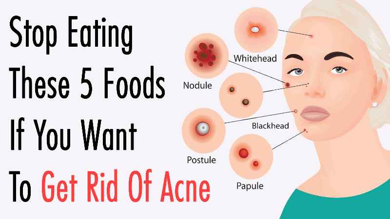 What food gets rid of acne
