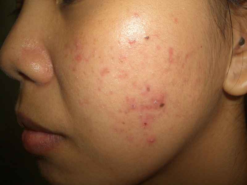 What foods cause acne
