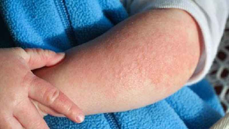 What foods trigger eczema flare ups