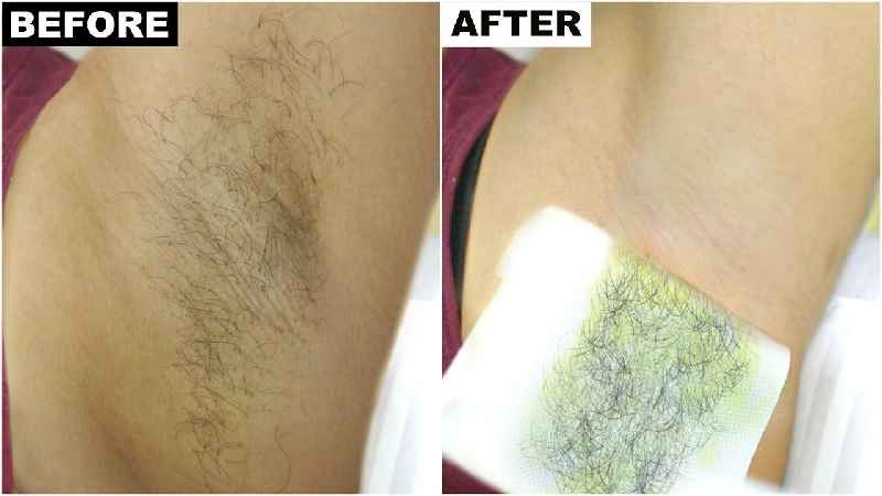What hair removal is best for pubic area
