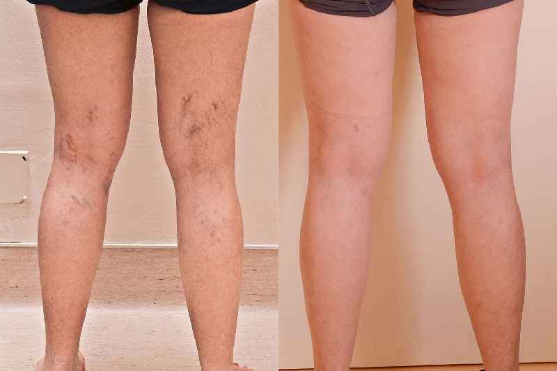 What happens after saphenous vein removal