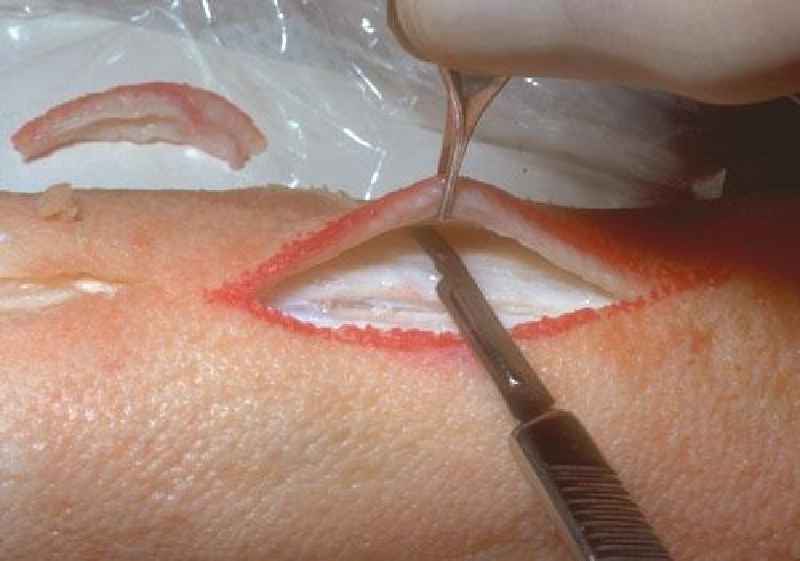 What happens if part of a stitch is left in the skin