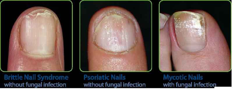What happens if the nail matrix is damaged