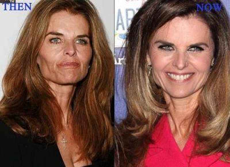 What happens if you gain weight after a facelift