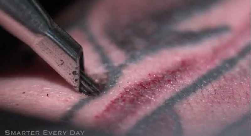 What happens if you laser over a tattoo