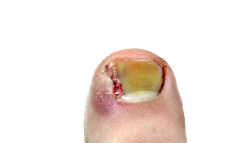 What happens if you leave a ingrown toenail untreated