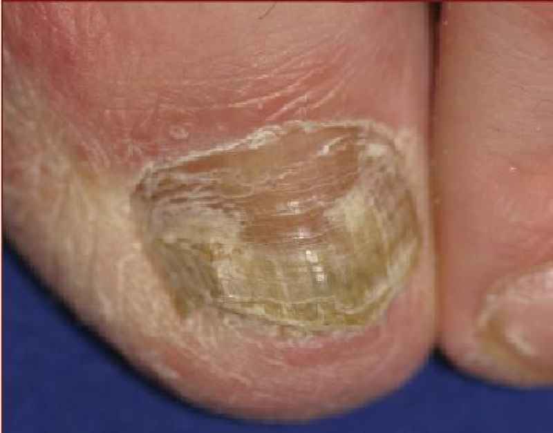 What happens if you leave blood under your nail