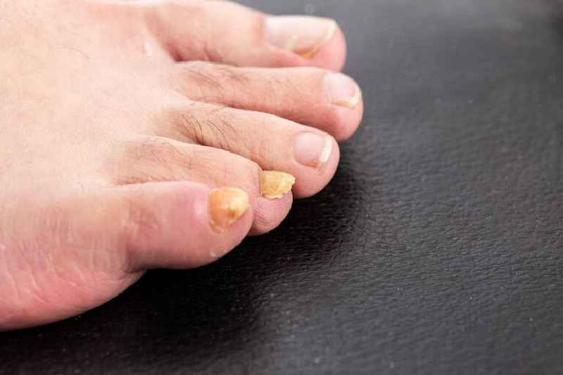 What happens if you leave toenail fungus untreated