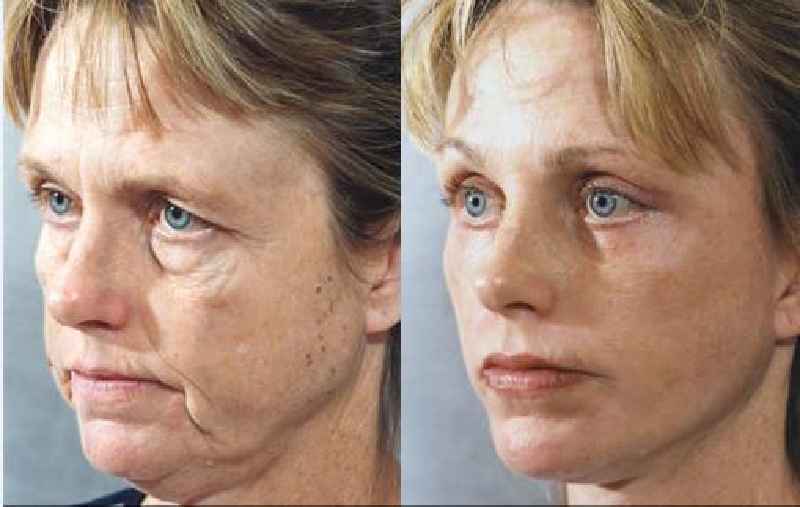 What happens if you lose weight after a face lift