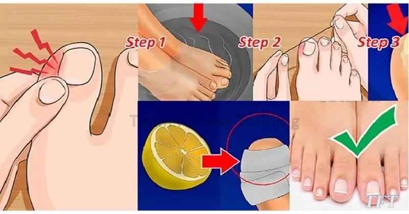 How To Take Care Of A Big Toe After Pulling The Nail Off 