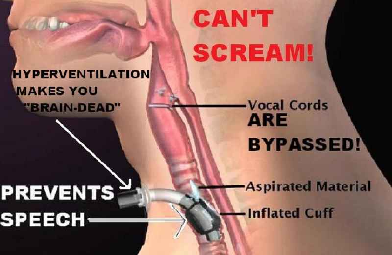 What happens if you stop breathing during anesthesia