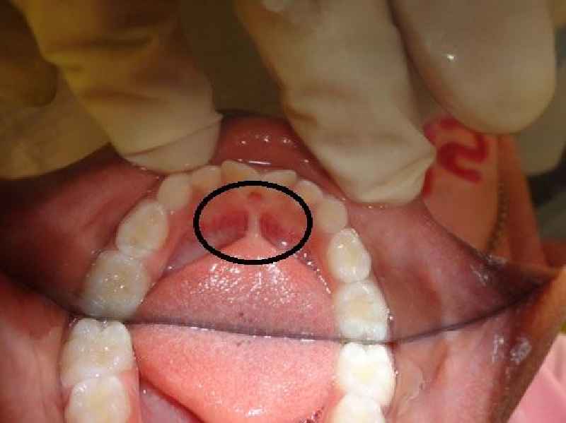 What happens to teeth under veneers