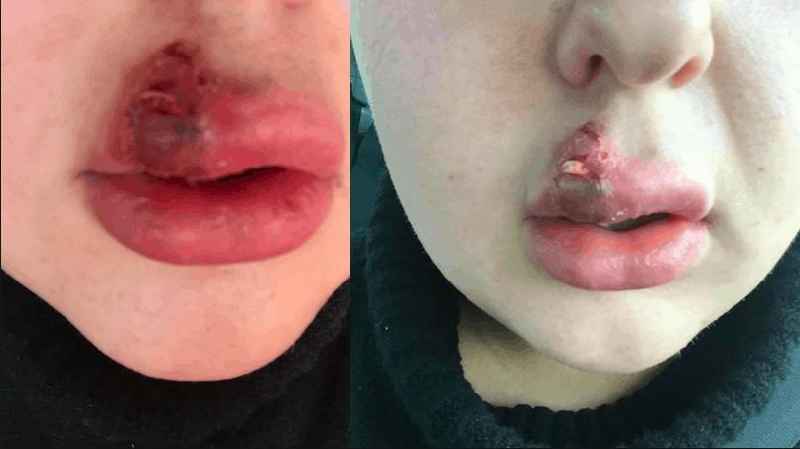 What happens to your lips when you stop getting fillers