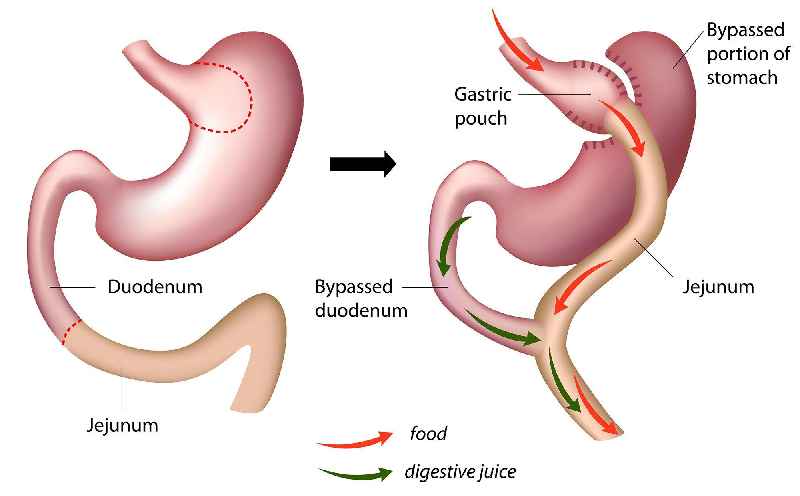 What happens to your old stomach after gastric bypass