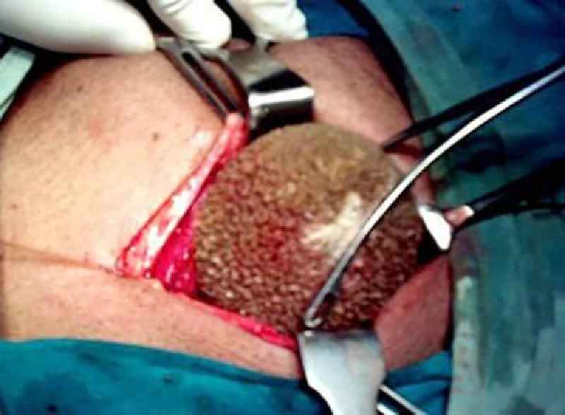 What happens when you have skin cancer removed