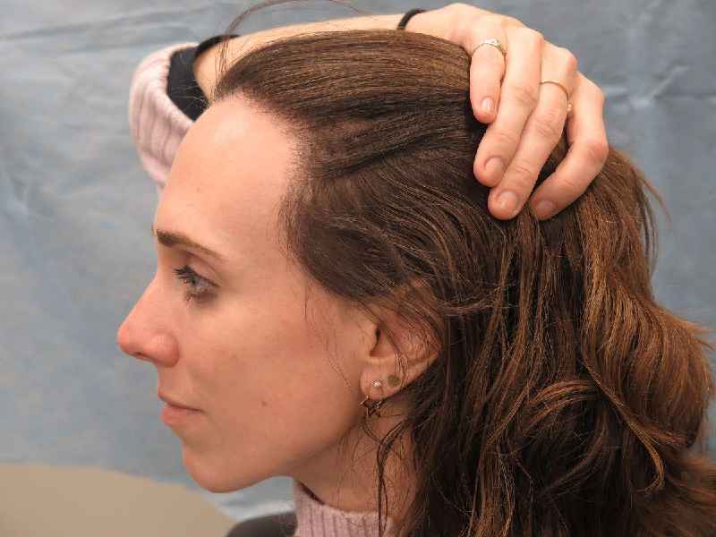 What helps female thinning hair
