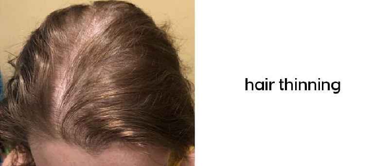 What helps thinning hair on top of women's head
