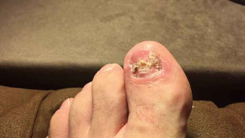 What helps with pain after toenail removal