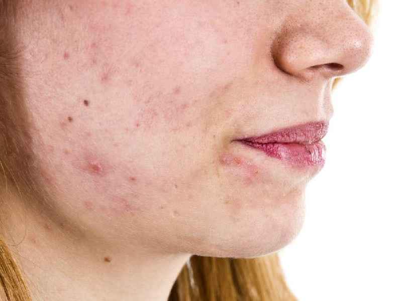 What hormone causes facial hair in females